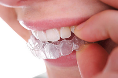 Orthodontic Services-Dental Clinic Calgary